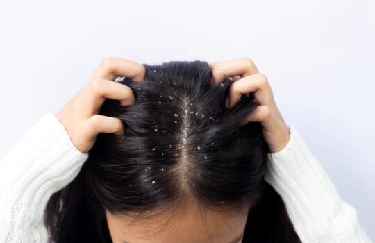 woman_dandruff
