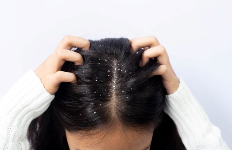 woman_dandruff